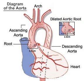 Aortic Aneurysm - Can I Still Get Life Insurance? - Agency One