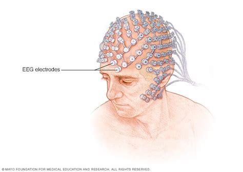 Temporal lobe seizure - Diagnosis and treatment - Mayo Clinic