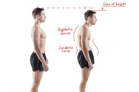 Common Posture Problems and How to Fix Them - Orthopaedic Specialty Group