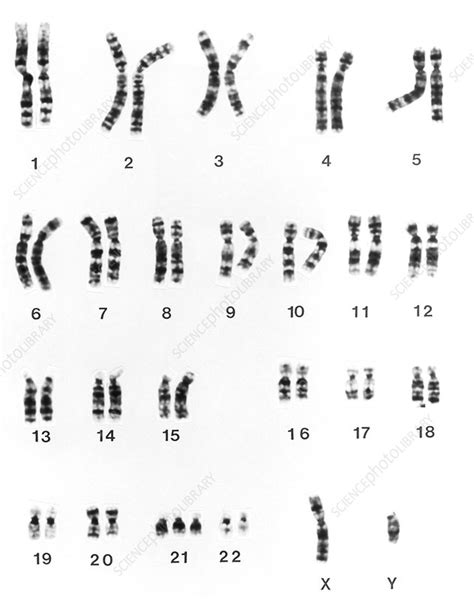 Karyotype of chromosomes in Down's syndrome - Stock Image M352/0002 - Science Photo Library