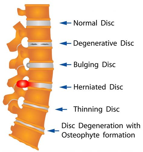 Modic Changes - My Family Physio