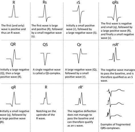 ECG interpretation: Characteristics of the normal ECG (P-wave, QRS complex, ST segment, T-wave ...