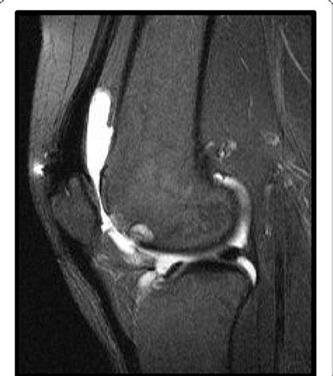 Sagittal slice image of a knee demonstrating central trochlear groove ...