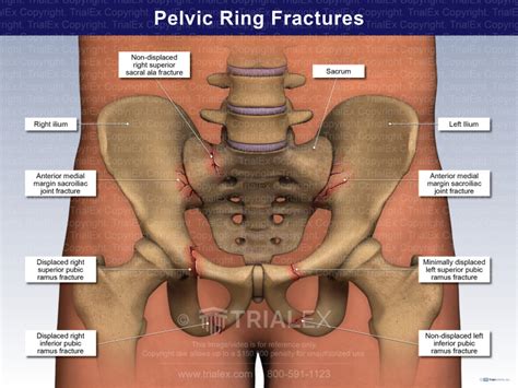 Pelvic Ring Fractures - TrialExhibits Inc.