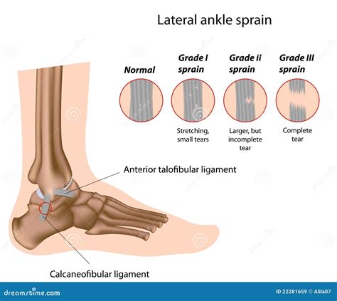 Ankle Sprain Grading Royalty Free Stock Images - Image: 22281659