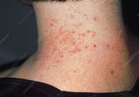 Contact dermatitis caused by necklace - Stock Image M320/0245 - Science Photo Library