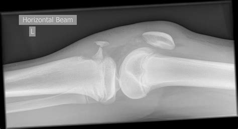 Tibial tuberosity avulsion fracture | Image | Radiopaedia.org