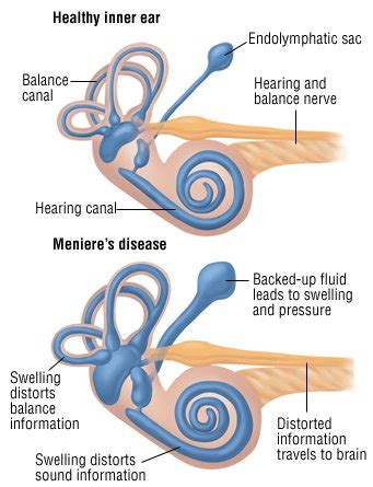 Meniere's Disease Guide: Causes, Symptoms and Treatment Options
