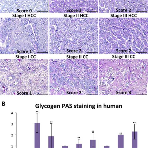 Periodic acid-Schiff (PAS) staining analysis of human liver disease... | Download Scientific Diagram