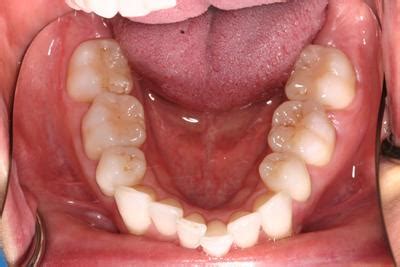 Invisalign Moderate Crowding