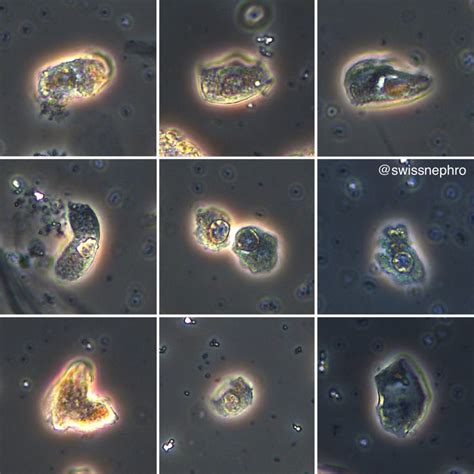 Urine Sediment of the Month: 4 Flavors of Nucleated Cells - Renal ...