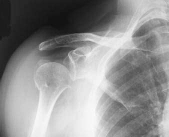 81 Shoulder and Proximal Humeral Fractures | Radiology Key