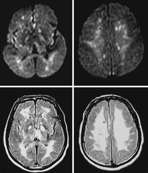 Hypoxic-Ischemic Brain Damage | Radiology Key