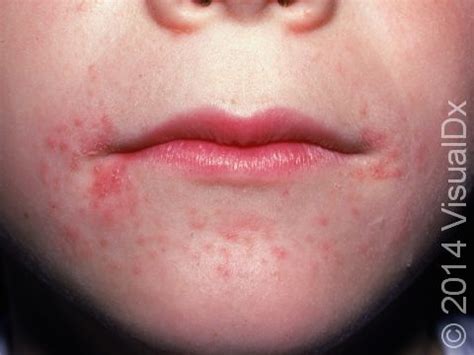 Perioral Dermatitis In Children