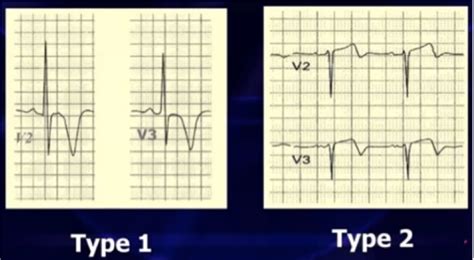 WELLENS’ SYNDROME – ECG Weekly