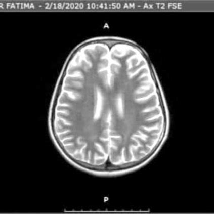 Axial MRI images at the level of third ventricle showing no abnormality. | Download Scientific ...