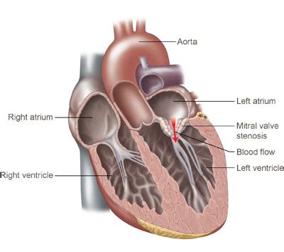 Mitral valve stenosis