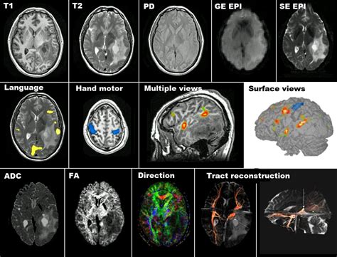 MRI and Medical Imaging: MRI and neurodegenerative diseases.