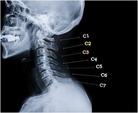 Cervical Whiplash - My Family Physio