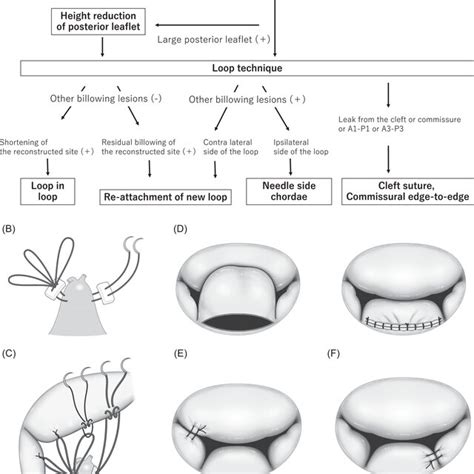 Annuloplasty with a semi-rigid ring. | Download Scientific Diagram