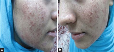 Gallery For > Demodex Folliculorum Rash