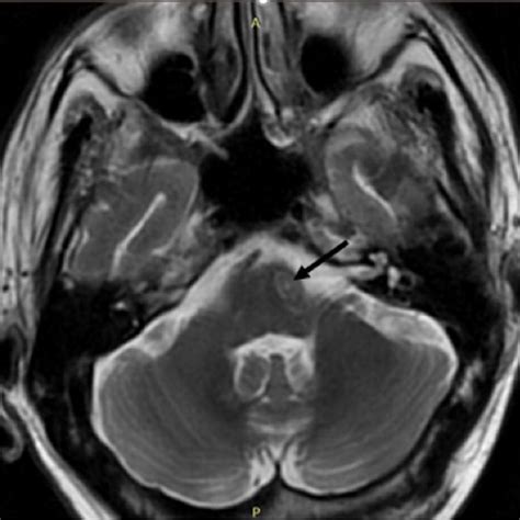 MRI brain showing ring-enhancing lesions. Ring-enhancing lesion in the... | Download Scientific ...