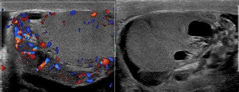 Multiparametric ultrasound finds causes for male infertility • healthcare-in-europe.com