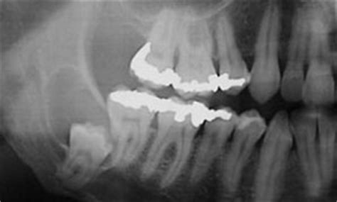 Management of a Deeply Impacted Mandibular Third Molar and Associated Large Dentigerous Cyst to ...