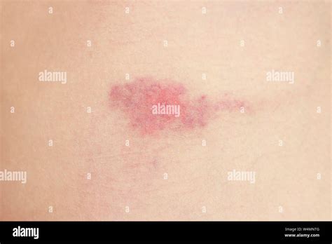 Midge Bite High Resolution Stock Photography and Images - Alamy