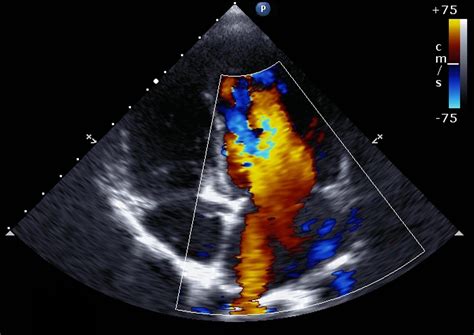 Echo AI Detects More Aortic Stenosis - The Imaging Wire