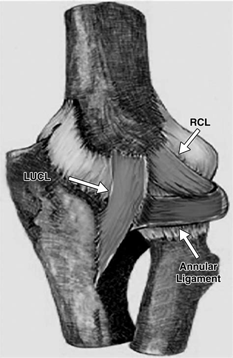 MRI of the Annular Ligament of the Elbow: Review of Anatomic Considerations and Pathologic ...