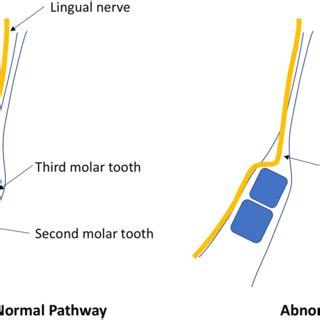 Retromolar Pad Anatomy