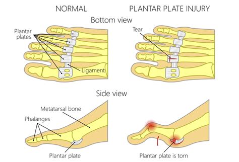 Understanding and Treating Second Toe Pain - Sport Doctor London