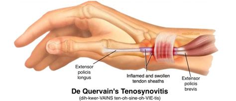 Tynor Australia Tagged "De Quervain’s Tenosynovitis"