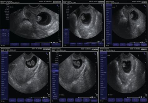 Transvaginal Ultrasound Revealed A Normal Sized Uterus Open I | SexiezPix Web Porn