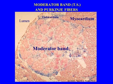 Moderator Band Histology