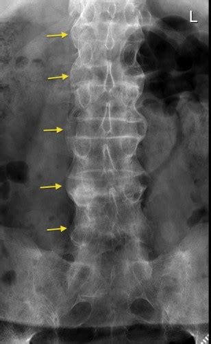 BambooSpine - Radiology at St. Vincent's University Hospital