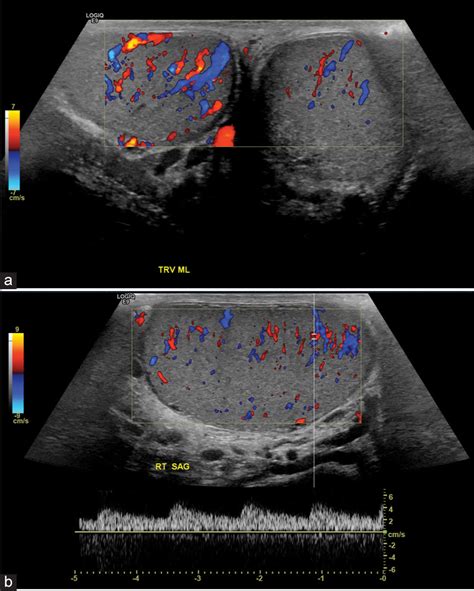 Inguinal Hernia Resulting in Testicular Ischemia - American Journal of ...