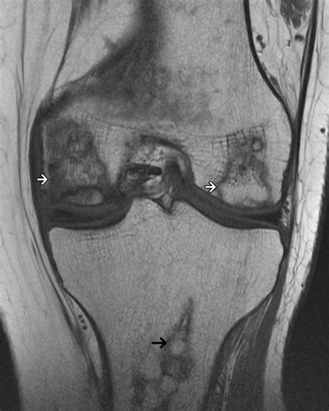 Knee Avascular Necrosis- Dr. Dennis M.Lox