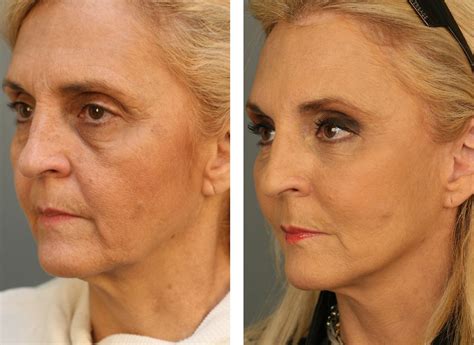 Oriental Facelift Gained With Workouts For The Face And Neck (With images) | Natural face lift ...