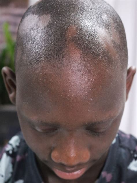 Alopecia Camouflage - The Dermatography Clinic