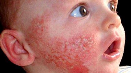 Dust mite allergy | Japan| PDF | PPT| Case Reports | Symptoms | Treatment