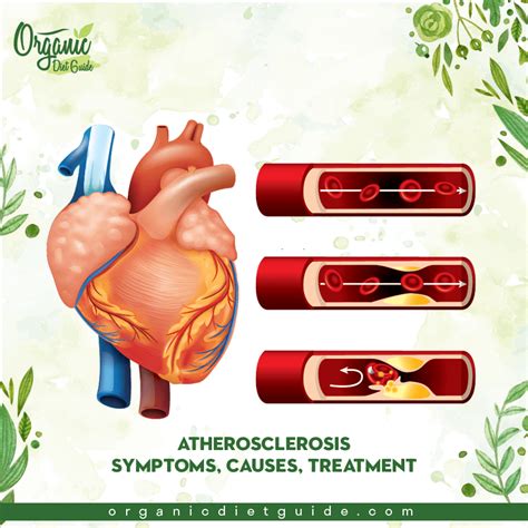 Pin on Cholesterol & Blocked Arteries