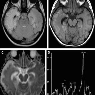 Hemorrhagic CMV encephalitis. T1W axial image ( A ) shows bilateral ...