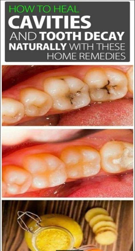 How to Heal Cavities and Tooth Decay Naturally with These Home Remedies - better health # ...