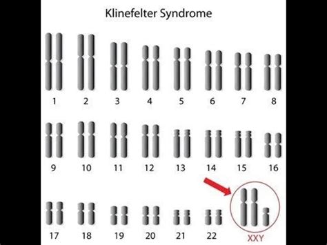 Klinefelter syndrome---Genetics, Characteristics, Diagnosis : usmle