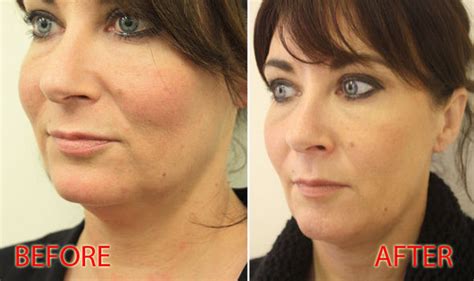 What is a thread lift? Before and after pictures show anti-ageing ...