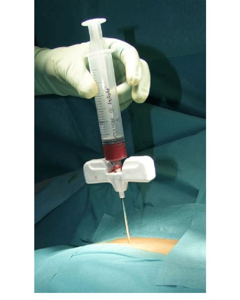 Posterior Iliac Crest Bone Marrow Biopsy