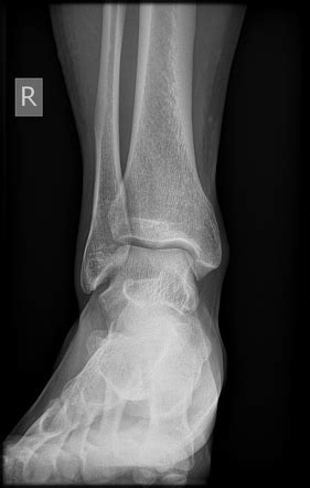 Normal ankle x-ray | Image | Radiopaedia.org