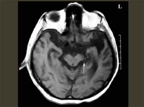 Brain herniation imaging